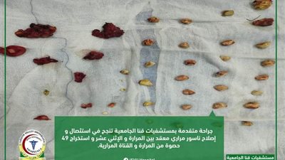 استخراج ٤٩ حصوة من القناة المرارية لمريضة بمستفيات قنا الجامعية
