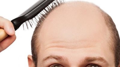 طرق علاج الصلع عند الرجال.. تعرف عليها