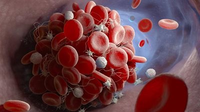 منها الثوم والكيوى .. أطعمة تذيب الجلطات الدموية