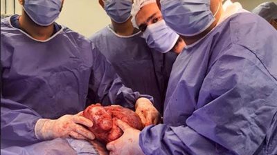 جراحة ناجحة . إستئصال ورم بالصدر يزن 4 ك بمستشفيات جامعة المنوفية
