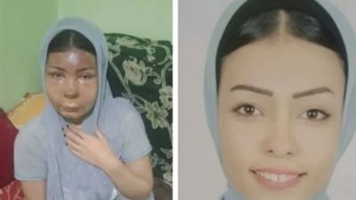 تجديد حبس شاب سكب مياه نار على وجه فتاة وجدتها لرفضهما خطبته