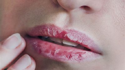 أسباب وعلاج تشقق الشفاه