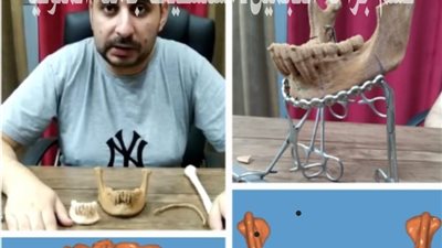 نجاح أول حالة إعادة بناء للفك بعد إستئصاله جراحيا لوجود ورم خبيث