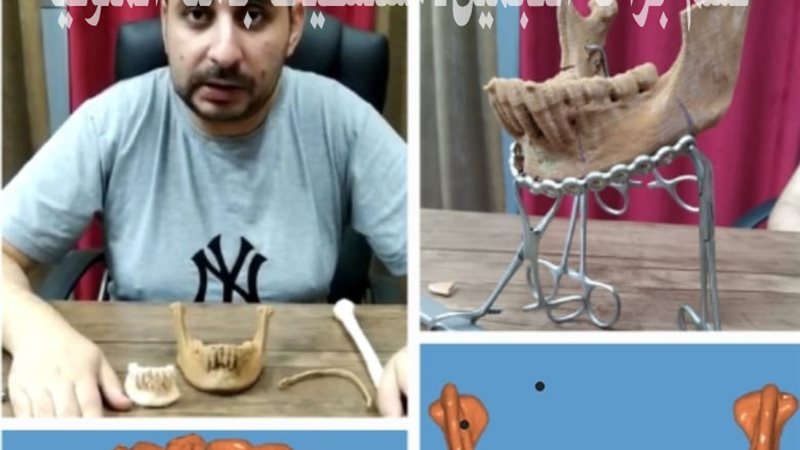 نجاح أول حالة إعادة