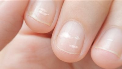 احذر هذه العلامات على أظافرك .. تشير لإصابتك بالسكري
