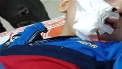 كلب ضال يصيب طفل بجروح خطيرة فى المنوفية