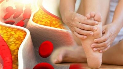 علامات اذا ظهرت عليك فإنك تعانى من ارتفاع نسبة الكوليسترول..احذر