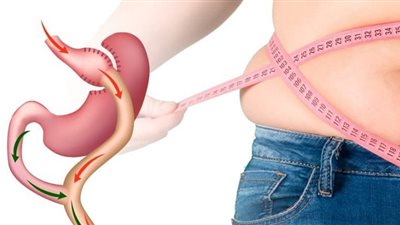أضرار عملية تكميم المعدة.. تعرف عليها