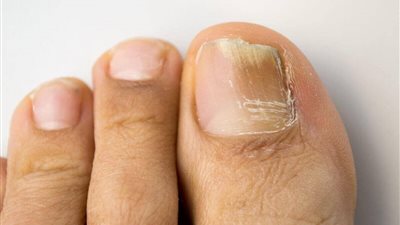 اهتم بعلاجها..فطريات الأظافر خطر على صحتك