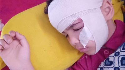 كلب ضال يعقر 4 أطفال بقرية رأس الخليج بالدقهلية