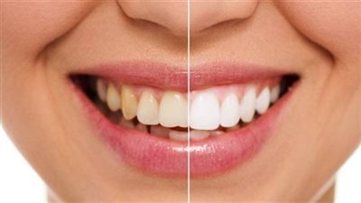 أطعمة ابتعد عن تناولها لحماية اسنانك من التسوس