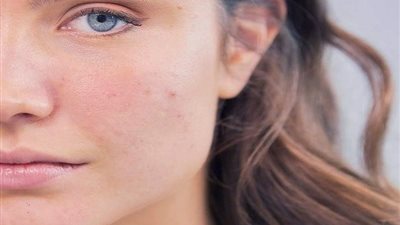 5 اسباب للمسام الواسعة ..تعرف عليها