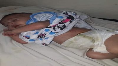لأول مرة .. ارجاع أمعاء خارج بطن طفلة في مستشفى الإسماعيلية العام مجانا
