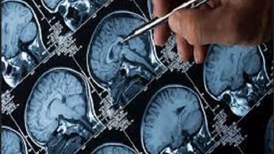 للوقاية من أورام الدماغ.. التخلي عن العادات السيئة