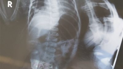 جراحة متقدمة لطفل عمره شهرين لإصلاح فتق بالحجاب الحاجز