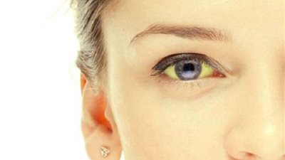 أبرز أعراض التهاب الكبد.. اصفرار لون العينين والبشرة