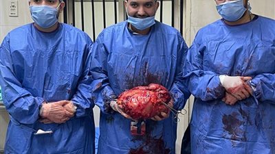 فريق طبي بمستشفيات جامعة أسيوط؛ ينجح في استئصال ورم