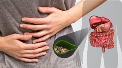 متى يكون التدخل الجراحي ضروريا في حالة حصى المرارة؟.. طبيب يجيب