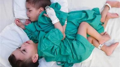 في عملية استغرقت 7 ساعات ..نجاح فصل التوأم السيامي إحسان وبسام