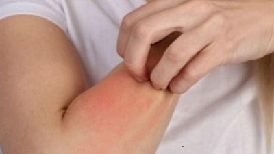 نصائح عند علاج حساسية الجلد من الحرارة