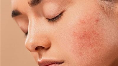 اهم طرق لعلاج ندوب الوجة