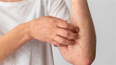 احترس من لدغات الناموس ..يسبب حمى الضنك وينقل أمراض خطيرة