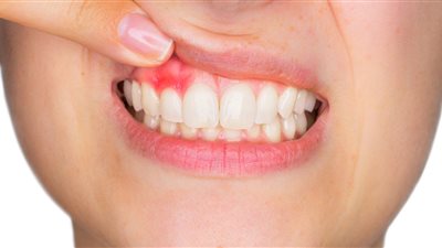 خطوات تحميك من التهاب اللثة..تعرف عليها