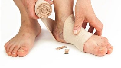 4 وصفات طبيعية للتخلص من الدوالي