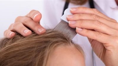 نصائح وحلول لتجنب إصابة الأطفال بحشرات الرأس