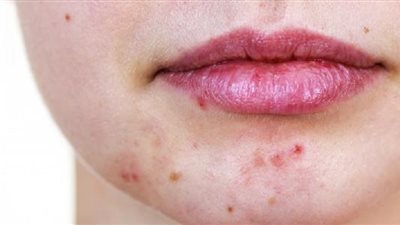 طرق طبيعية للتخلص من آثار الحبوب.. تعرف عليها