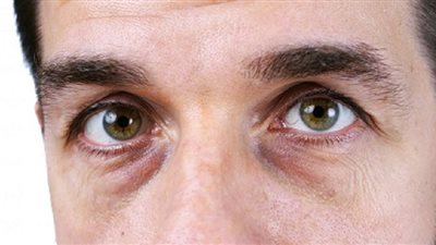 تعرف على أسباب وأنواع الهالات السوداء
