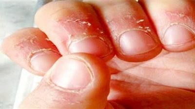 تعرف على أسباب تقشر الجلد حول الأظافر