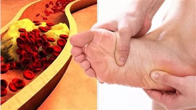 احذري علامات غير شائعة لارتفاع الكوليسترول