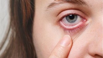 أنواع حساسية العين وأعراضها.. تعرف عليها
