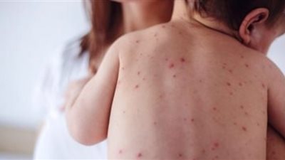 الصحة الرومانية تعلن انتشار وباء الحصبة
